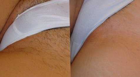 udalenie-volos-v-intimnih-mestah-navsegda udalenie-volos-v-intimnih-mestah-navsegda